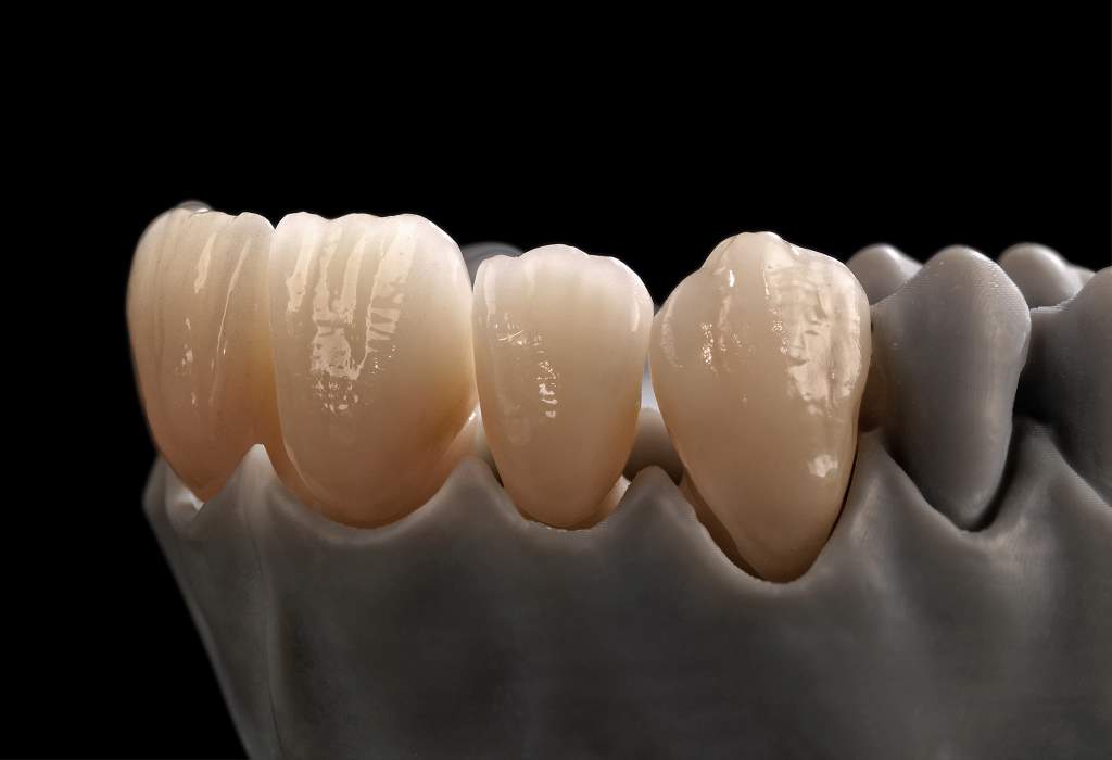 Typical dental prostheses produced in a Ceramill Matik